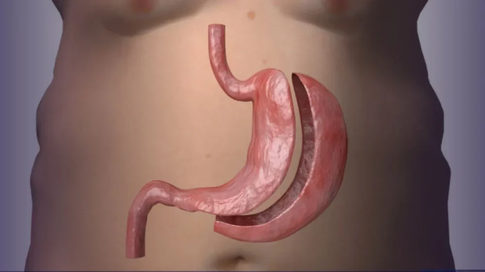 CFM publica resolução que estabelece novos parâmetros para a cirurgia bariátrica e metabólica no Brasil